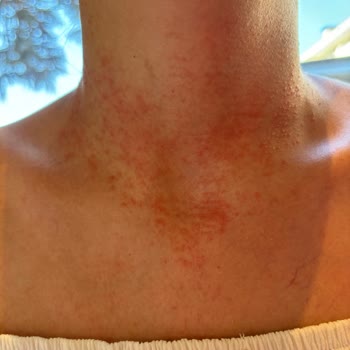 Eda Taşpınar SPF 20 Bronzlaştırıcı Cilt Reaksiyonu Yaptı