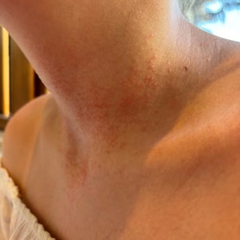 Eda Taşpınar SPF 20 Bronzlaştırıcı Cilt Reaksiyonu Yaptı