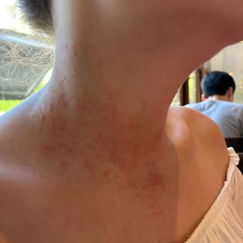 Eda Taşpınar SPF 20 Bronzlaştırıcı Cilt Reaksiyonu Yaptı