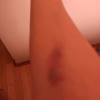 Medistate Kavacık Hastanesi Hemşireleri Damar Yolu Açamıyor