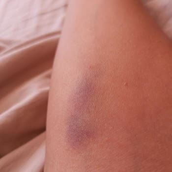 Medistate Kavacık Hastanesi Hemşireleri Damar Yolu Açamıyor