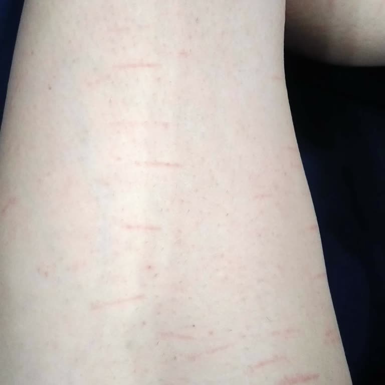 İstanbul Clinic İstanbul Klinik Samsun Şubesi Lazer Yanığı Şikayeti