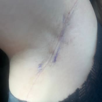 Dr. Ebru Şen Estetik Operasyonundan Sonra Yaşadığım Hayal Kırıklığı