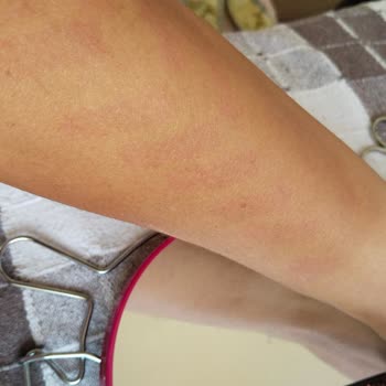 Braun Kişisel Bakım Ürünleri IPL Lazer Epilasyon Aleti Vücudumu Yakarak İzler Yaptı!