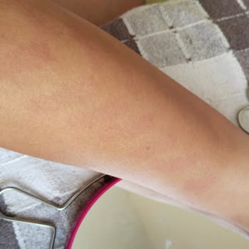 Braun Kişisel Bakım Ürünleri IPL Lazer Epilasyon Aleti Vücudumu Yakarak İzler Yaptı!