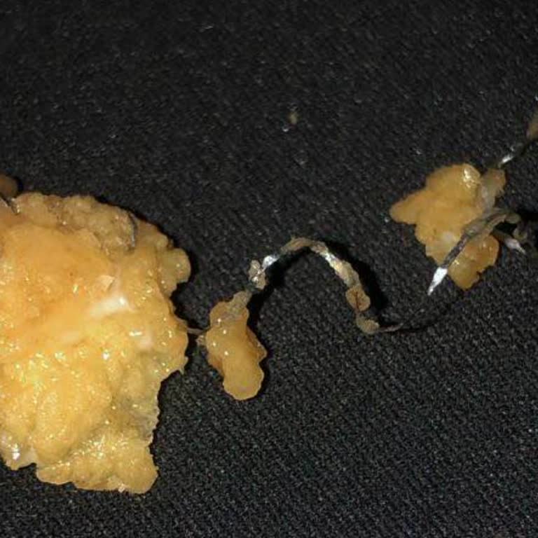 Popeyes Yemeğimden Metal Tel Çıktı