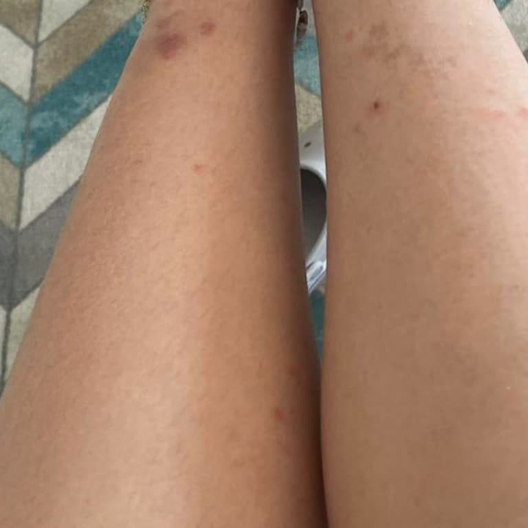 Holiday Inn Bodrum Flöhe im Zimmer und mangelhafter Service – Rückerstattung gefordert