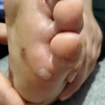 Rituel De Beaute Ayağımda Mantara Sebep Oldu