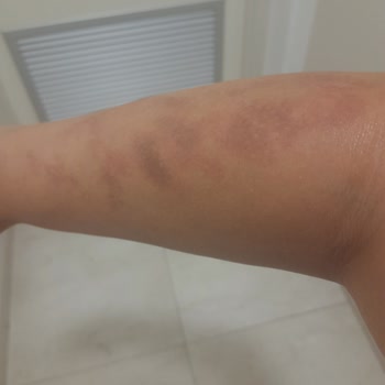 Monalisa Sağlıklı Güzellik Lazer Epilasyon Seansı