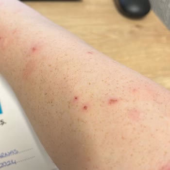 Vivense Koltuk Takımında Tahta Kurusu