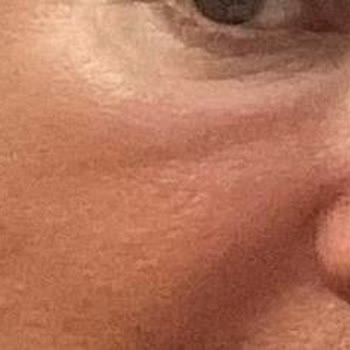 Medialkent Clinic Gözaltımda Kalıcı Şişlik Oluştu