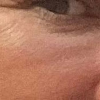 Medialkent Clinic Gözaltımda Kalıcı Şişlik Oluştu