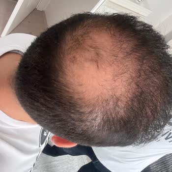 Ekrem Civaş Klinik Saç Kök Hücre Tedavisi Deneyimim