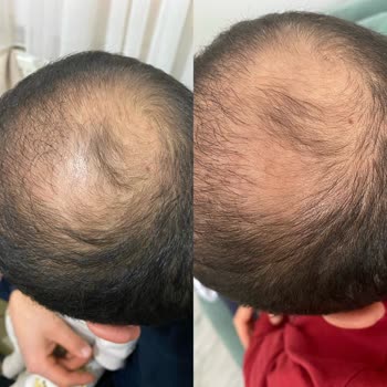 Ekrem Civaş Klinik Saç Kök Hücre Tedavisi Deneyimim