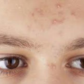 Estee Lauder Advanced Night Repair 4'lü Set'i Sivilce Şikayeti