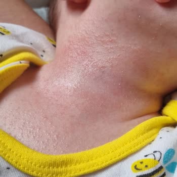 Mustela Stelatopia Alerjik Reaksiyona Sebep Oldu