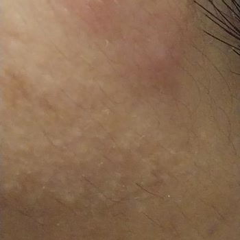 Havuzdaki Kimyasallar Her Şeyi Yaktı - Bizimtepe Aydos Evleri