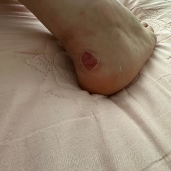 Skechers Ayakkabı Vurma Problemi
