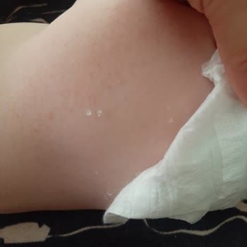 Bebem Natural Parçacıklar Ve Ciltteki Kabarmalar