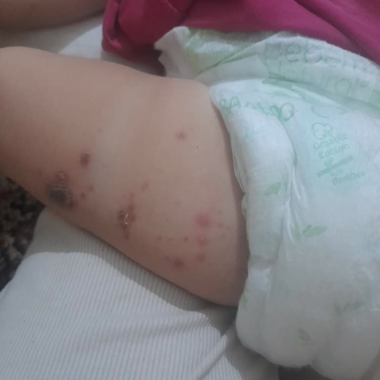 Bebem Natural Bebek Bezi Kullanımı Sonrası Cilt Sorunları