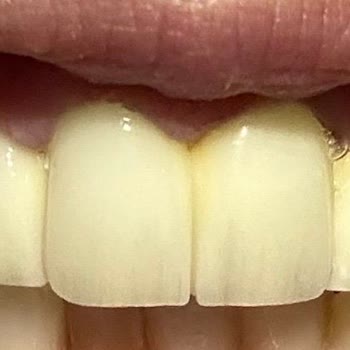 Vialife Estetik Vialife Zirkonyum Pişmanlığı