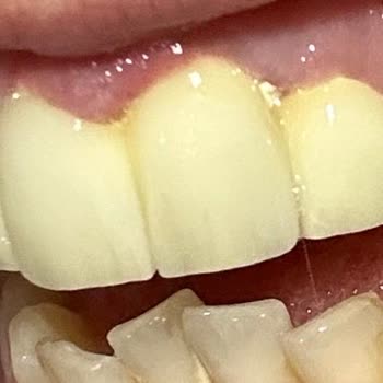 Vialife Estetik Vialife Zirkonyum Pişmanlığı