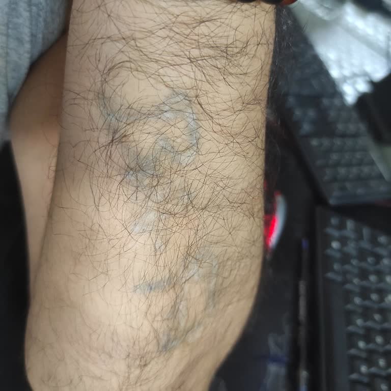 GNA Estetik Bakırköy Gna Beauty Dövme Silme İşlemi