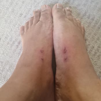 Kinetix Marka Terlik Ayaklarımı Yara Yaptı