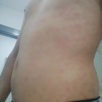 Veet Ürün Yan Etki Yaptı