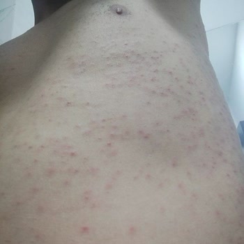 Veet Ürün Yan Etki Yaptı