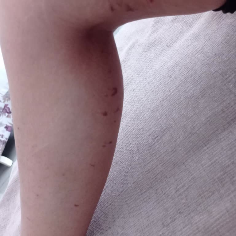 Eylül Berberoğlu Lazer Sonucu Oluşan Yanıklar