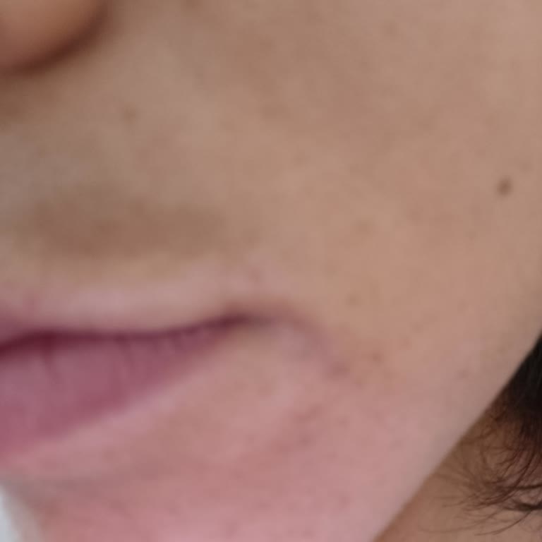 Selin Beauty Center Güzellik Merkezi Lazer Sonucu Bıyık Bölgesinde Kararma