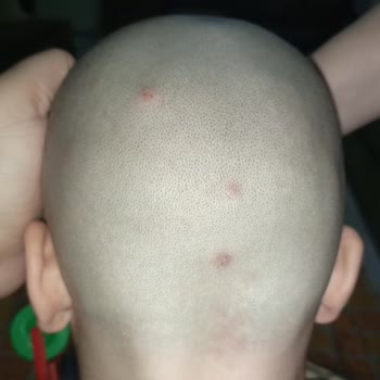 Sağlık Bakanlığı Uyuz Hastalığı İlacı İşe Yaramadı!