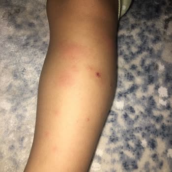 Enterogermina Alerjik Reaksiyonlar Yapıyor