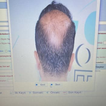 Selda Hair Center Saç Ekim İşlemi Mağduru