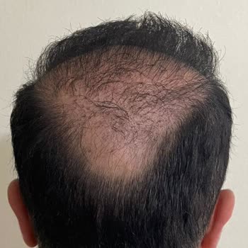 Selda Hair Center Saç Ekim İşlemi Mağduru