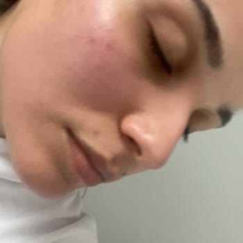 Neutrogena Yüz Temizleme Jelinden Yanan Yüzüm