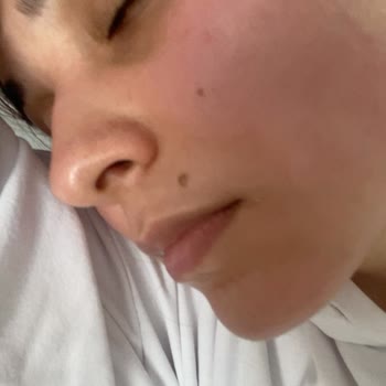 Neutrogena Yüz Temizleme Jelinden Yanan Yüzüm