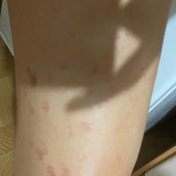 Zeynep & Tülay Beauty Bursa'daki Güzellik Merkezinde Yaşanan Lazer Epilasyon Problemleri