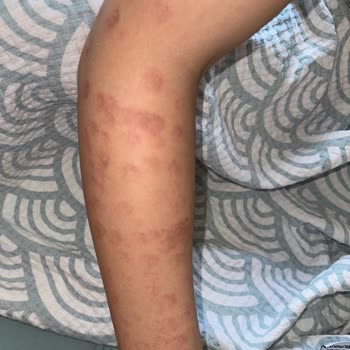 Zeynep & Tülay Beauty Bursa'daki Güzellik Merkezinde Yaşanan Lazer Epilasyon Problemleri