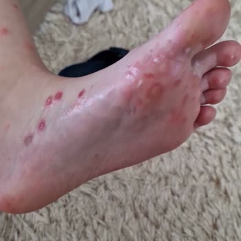 Eftalia Hotels Hijyen Sorunları Ve Sağlık Problemleri