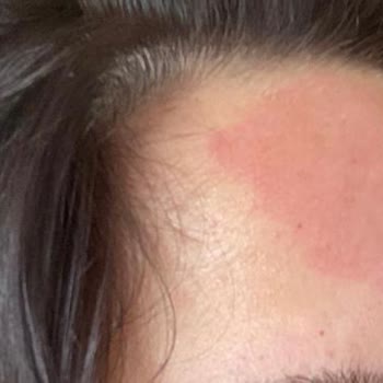 Dalin Şampuan Kızımın Suratına Alerji Yaptı Resmen Yanık Gibi Oldu