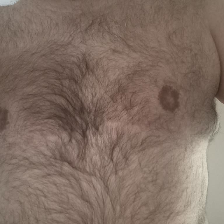 Estecenter Jinekomasti Operasyonu Sonrası Hüsran