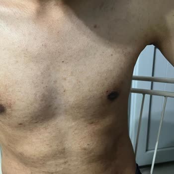 Merve Uzun Beauty Lazer Epilasyon Sonucu Yanık Oluşumu