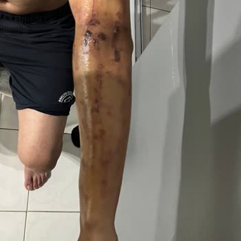 Merve Uzun Beauty Lazer Epilasyon Sonucu Yanık Oluşumu