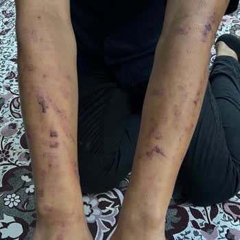 Merve Uzun Beauty Lazer Epilasyon Sonucu Yanık Oluşumu