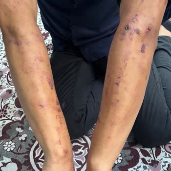 Merve Uzun Beauty Lazer Epilasyon Sonucu Yanık Oluşumu