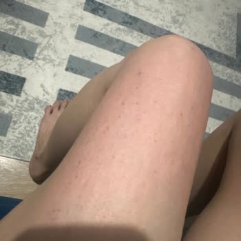 Vaseline Gluta Hya Losyonu Alerji Yaptı