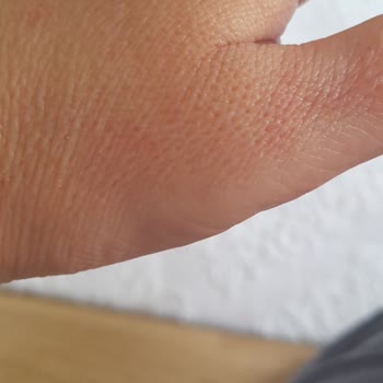 Vaseline Gluta Hya Losyonu Alerji Yaptı