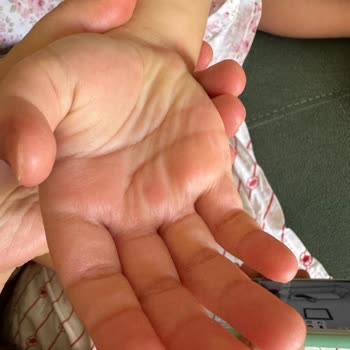 Argivit Smart'tan Kaynaklı Alerji